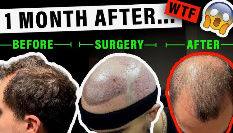 Hair Transplant Turkey Cost – What To Watch Out For